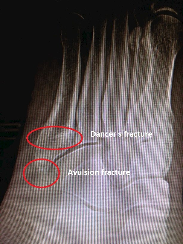 5th metatarsal avulsion and dancer's fracture